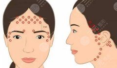 新的臉部提升微整方法是什么？分享除皺緊膚指南！