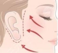 做拉皮手術(shù)多長時間能完全恢復？術(shù)前4大問題，科普分享！