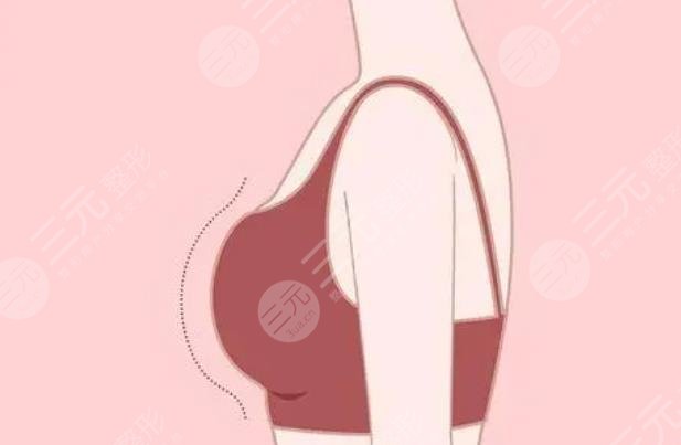 胸部注射物質(zhì)取出