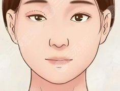 眼綜合和全切雙眼皮有啥區(qū)別？速來看看相關區(qū)別在哪