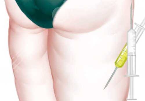 抽脂大腿大約需要多少錢