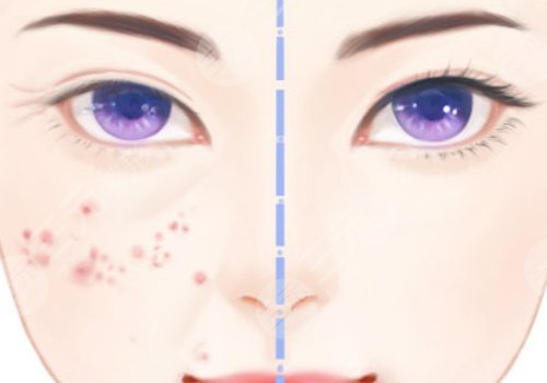 縮小毛孔的醫(yī)美項(xiàng)目