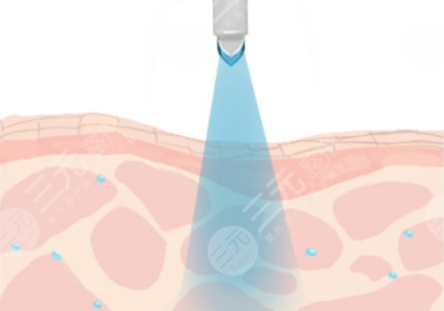 縮小毛孔的醫(yī)美項(xiàng)目