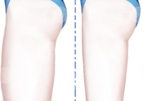 吸脂瘦大腿一般多少錢