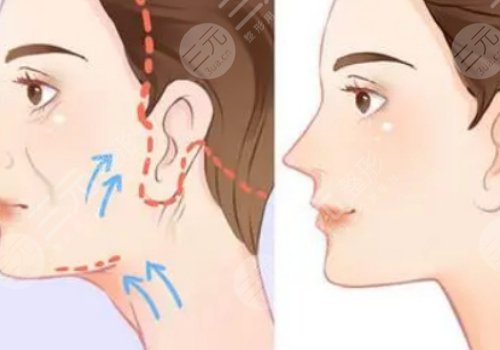 做拉皮手術(shù)能保持多少年