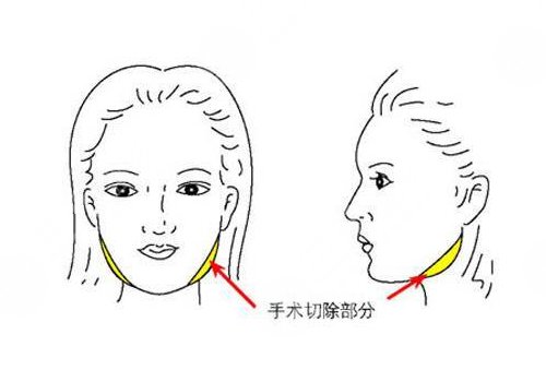 下頜角磨骨手術(shù)風(fēng)險(xiǎn)大嗎