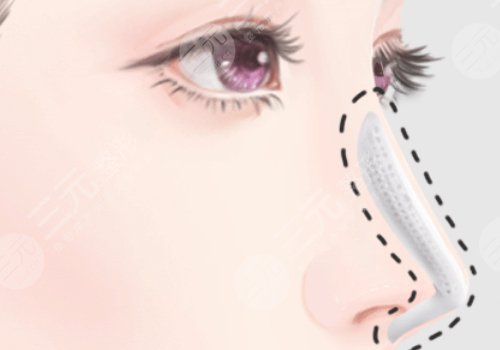 隆鼻想長(zhǎng)久建議硅膠還是膨體