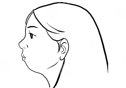 下頜骨后縮怎么矯正