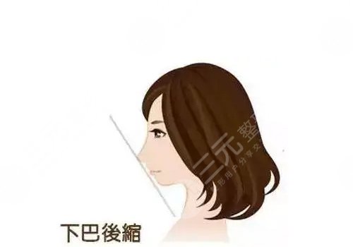 下頜骨后縮怎么矯正