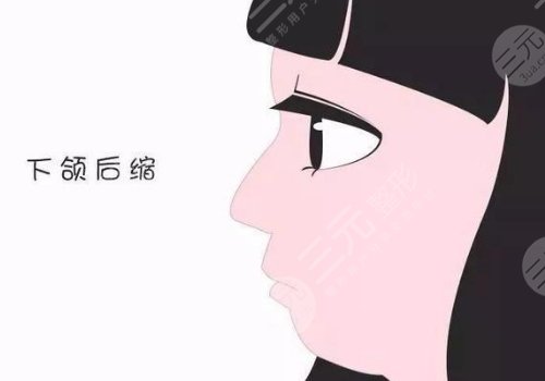 下頜骨后縮怎么矯正
