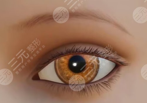 譚鶩遠(yuǎn) 雙眼皮案例