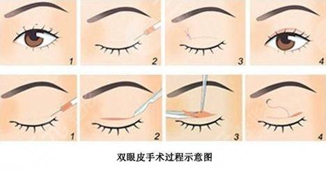 劉曉吉雙眼皮案例