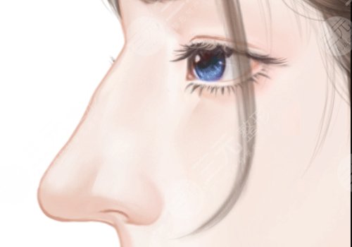 鼻假體膨體材料有哪些牌子