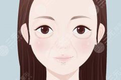 淚溝凹陷怎么？眼周年輕化打造，注射填充指南！