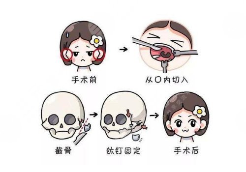 下頜骨手術(shù)費用大概多少