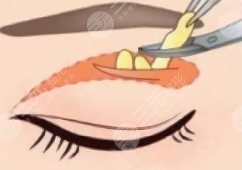 恢復快的雙眼皮做法是什么