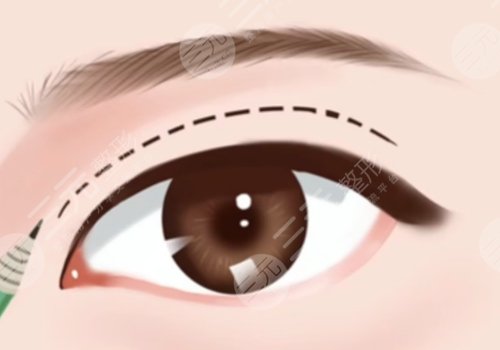 弋磯山醫(yī)院雙眼皮手術(shù)