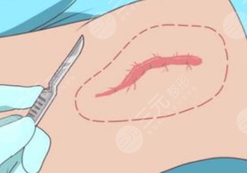 青島大學(xué)附屬醫(yī)院整形科疤痕植皮修復(fù)