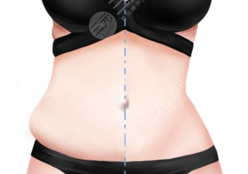 腰部環(huán)形吸脂手術大概多少錢