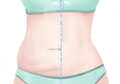 腰部環(huán)形吸脂手術大概多少錢