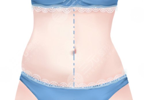 腰部環(huán)形吸脂手術大概多少錢