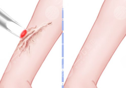 蘇州附二院祛疤多少錢(qián)