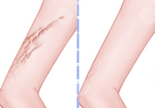 蘇州附二院祛疤多少錢(qián)