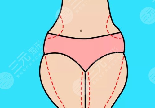 腰腹吸脂多久可以側(cè)身睡覺(jué)