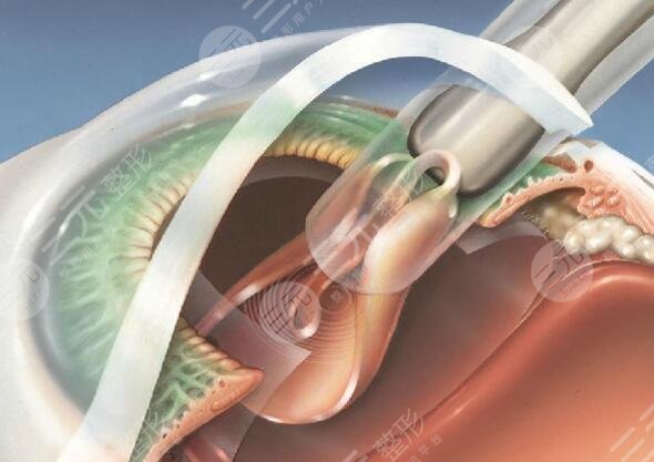 白內(nèi)障晶體植入