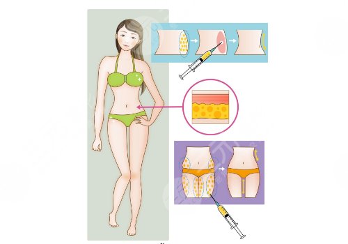 大腿抽脂費(fèi)用