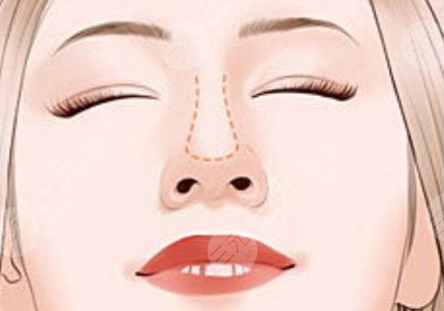 梁進(jìn)華做鼻子怎么樣