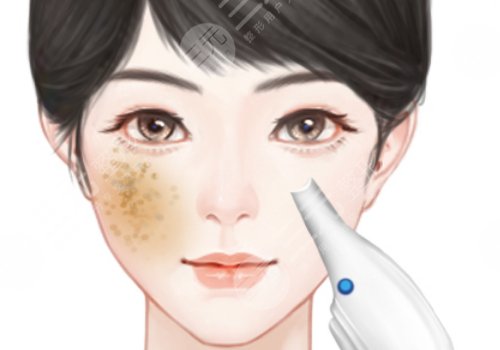 e光整形美容嫩膚祛斑