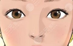雙眼皮割深了補救方法是什么？割雙眼皮手術多久才能恢復