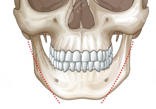 下頜角整形手術(shù)費用
