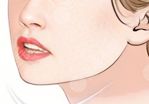 下頜角整形手術(shù)費用