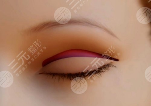 割雙眼皮第七天恢復(fù)圖