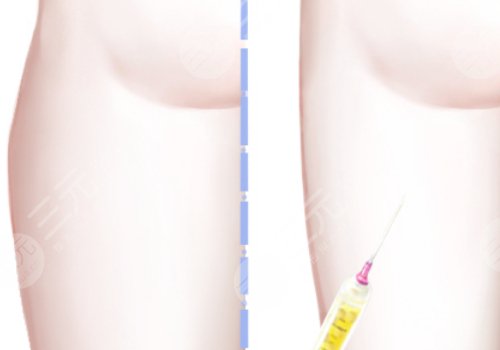 大腿吸脂手術(shù)