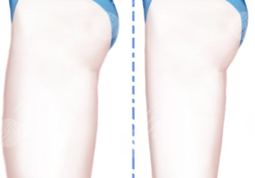 大腿吸脂手術(shù)