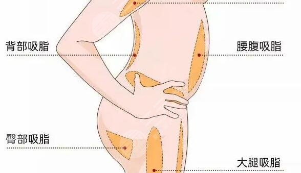 腰腹吸脂