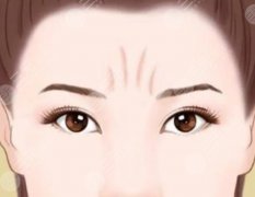 川字紋除皺針副作用大嗎？科普分享，緊膚淡紋沒那么嚇人！