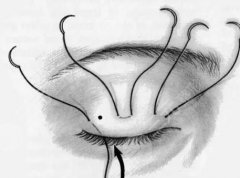 定點雙眼皮是持久的嗎？手術原理科普，看看你適合不！