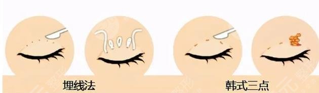 埋線雙眼皮