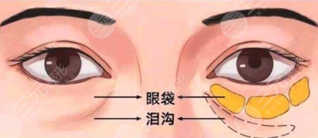 寧波市第六醫(yī)院整復外科祛眼袋多少錢?