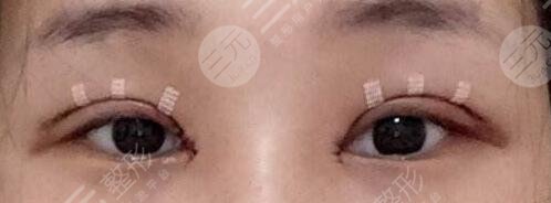 雙眼皮修復(fù)術(shù)后小tips
