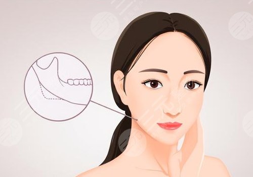 下頜角手術(shù)一個月效果