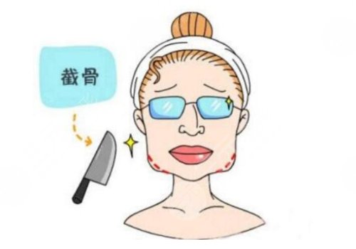 下頜角手術(shù)一個月效果