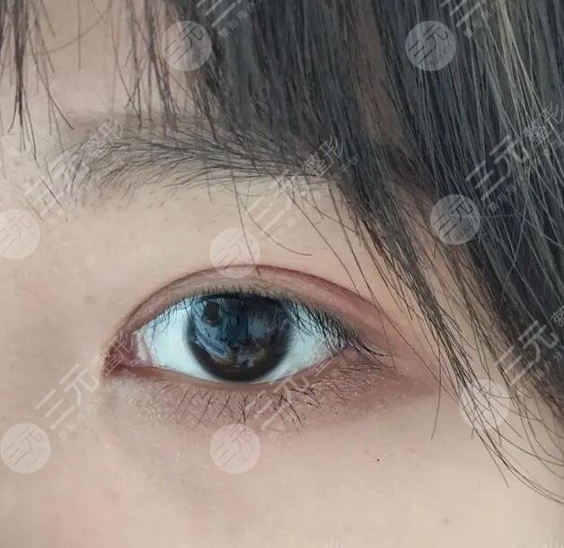 全切雙眼皮手術(shù)