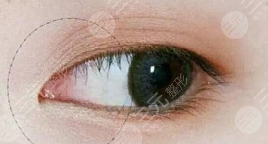 李桂珍醫(yī)生雙眼皮手術(shù)案例