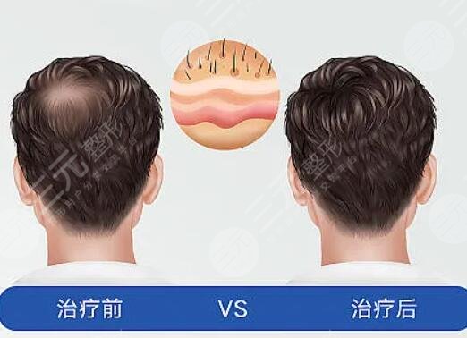 江蘇省中醫(yī)院植發(fā)多少錢?