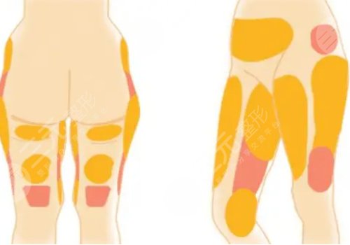 大腿內(nèi)側(cè)吸脂多少錢